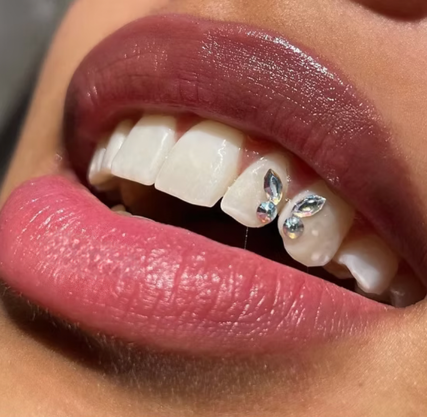 Close-up of Swarovski tooth gem application in Cork at Smiley Dogg Tattoo