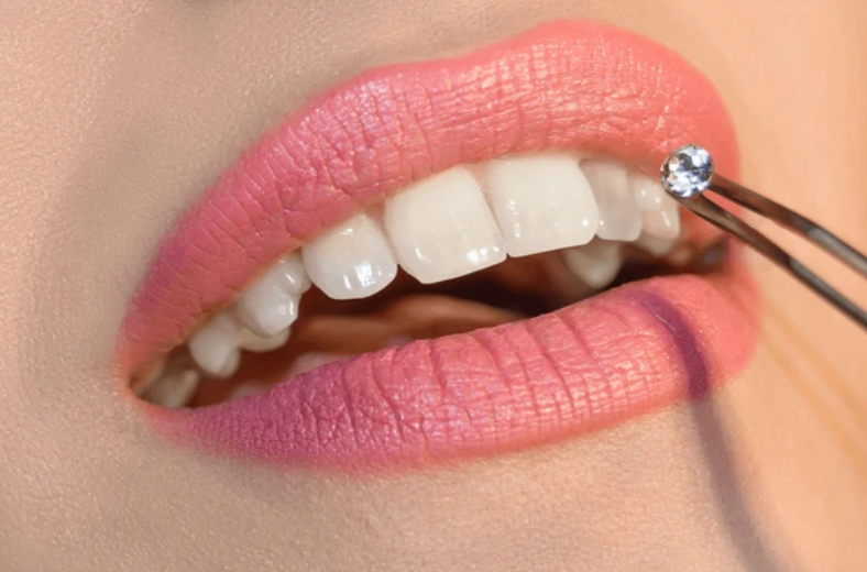 Professional artist applying luxury tooth gems at Smiley Dogg Tattoo Cork